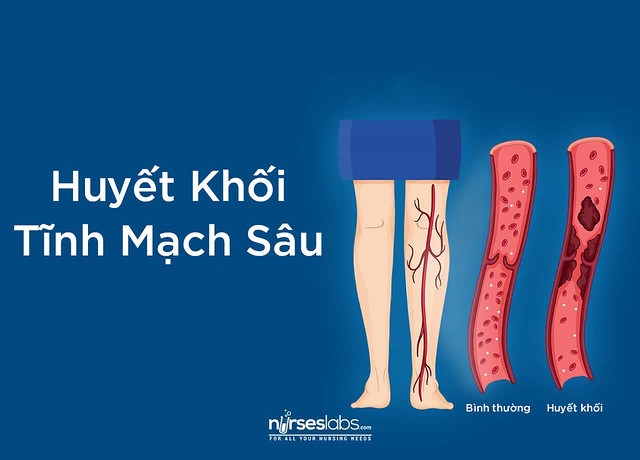 Huyết khối tĩnh mạch sâu hình thành ở chân