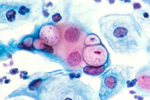 Vi khuẩn Chlamydia trachomatis nhuộm màu trên lam kính, quan sát dưới kính hiển vi